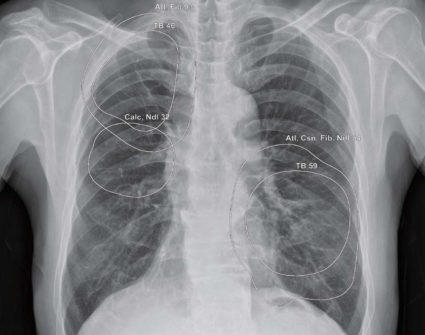 Snímek hrudníku s funkcí CXR Assist